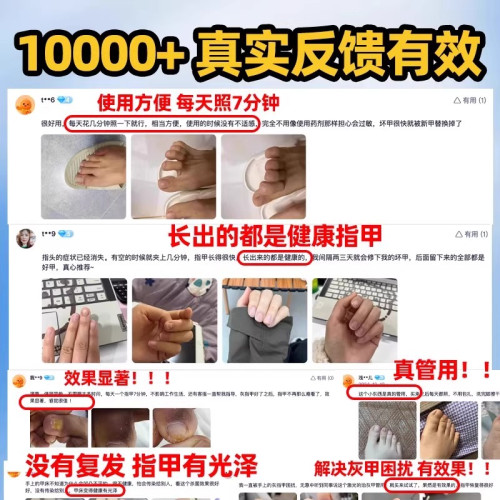 灰指甲光療機真菌燈紅外線雷射腳指甲治理療儀工具灰甲智能光療儀